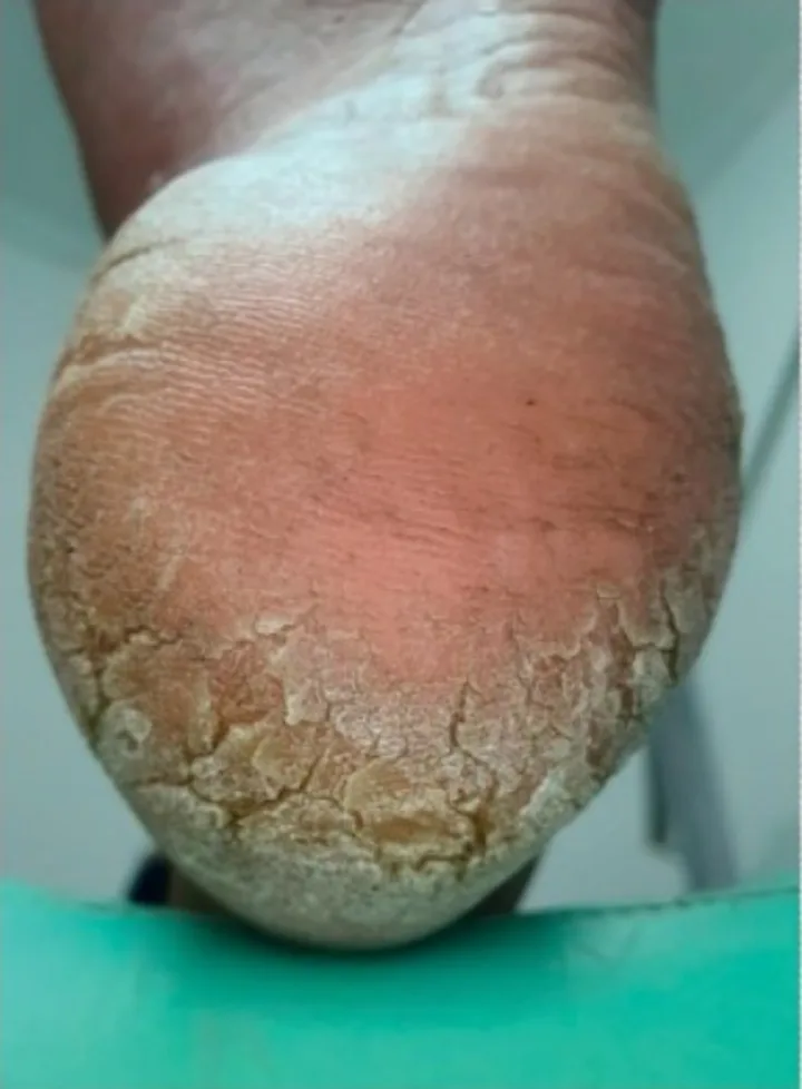Calcanhar com fissuras e pele espessa, antes do atendimento