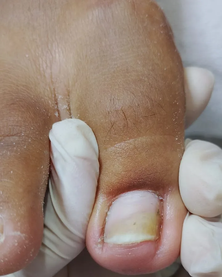 Dedo com unha encravada e inflamação no canto, antes